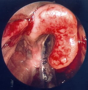 Epiglottitis - Laryngoscopy