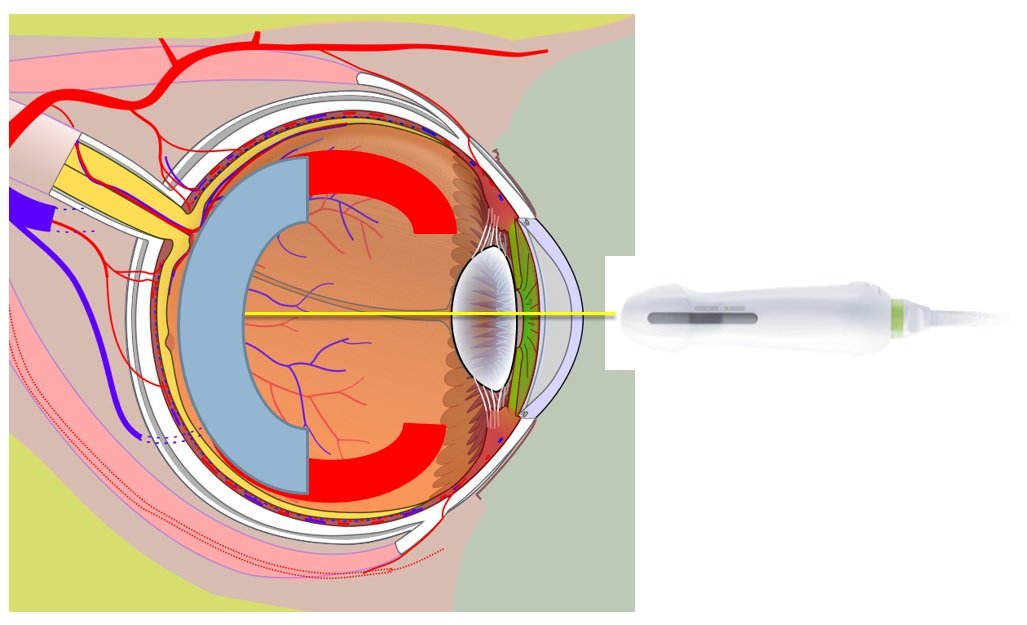 Figure 3: The extent of the retina missed by the sweep in Figure 2 is represented by bright red semi-circles. The actual retina tissue is the yellow layer below that thins out and terminates at the ora-serrata.