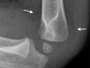 elbow fracture