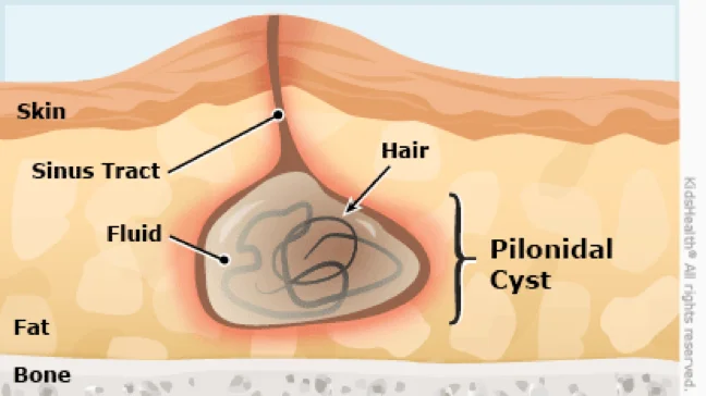 Pilonidal cyst Flashcards