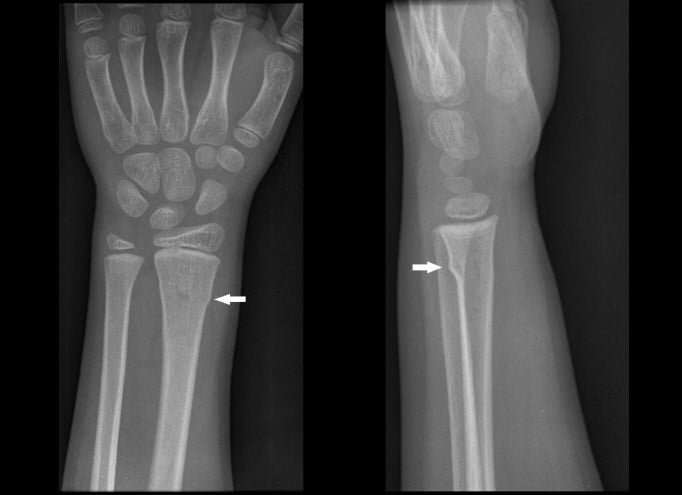 acute buckle fractures of the distal radius and ulna. icd 10