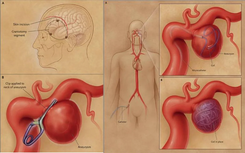 Subarachnoid Hemorrhage (SAH) - Willis-Knighton Health System