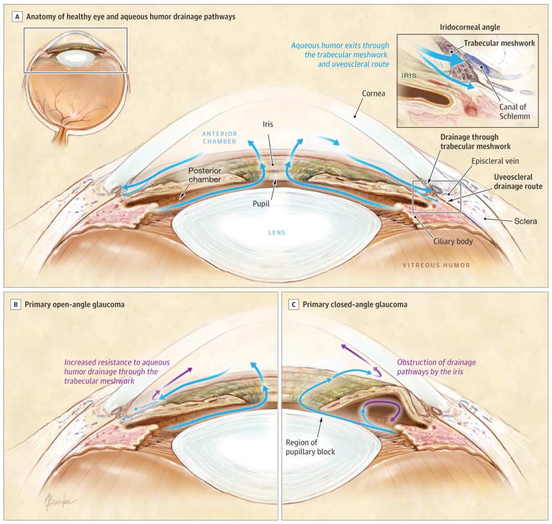 angle closure glaucoma vs open angle