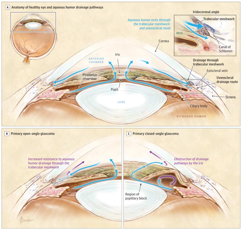 open angle glaucoma eye