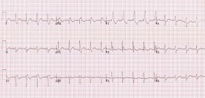 Figure 13: Bifascicular block – RBBB + LASFB (rS morphology inferiorly and left-axis deviation) [8]