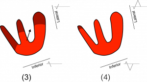 Figure 4: Cardiac depolarization with a blocked LASF, part 2
