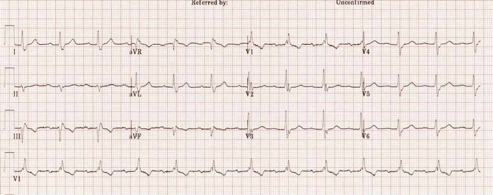 Image courtesy of LITFL ECG library