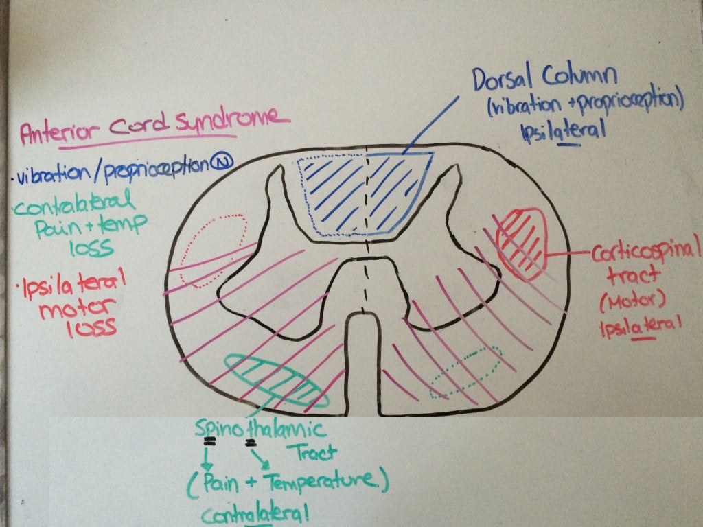 anterior cord syndrome