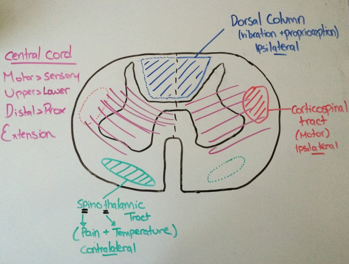 A Boring Guide To Spinal Cord Syndromes Canadiem 3784