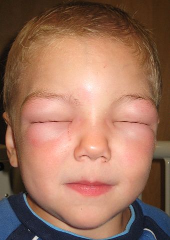 Anaphylaxis treatment