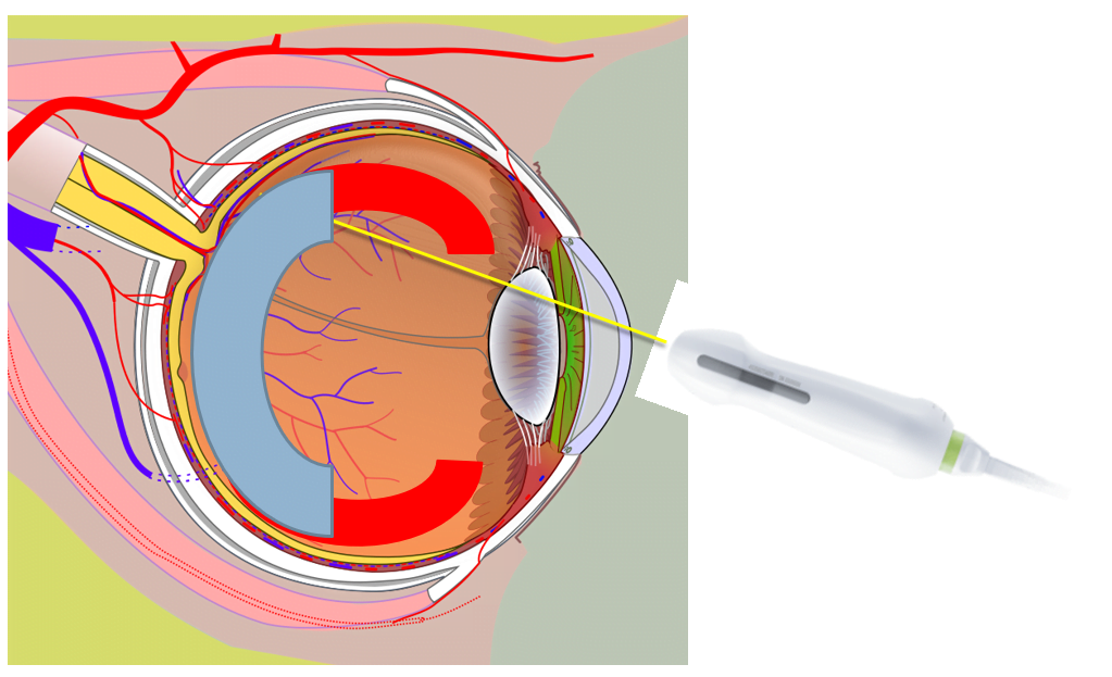 Figure 4: Common limits of the retina scan. Sweeping the probe at steeper angles is usually limited by the facial bones / soft tissue or the probe loses contact with the curved surface of the eye. Blue arc represents the portion of the retina already scanned. The red arcs represent portions of the retina that have not been scanned.