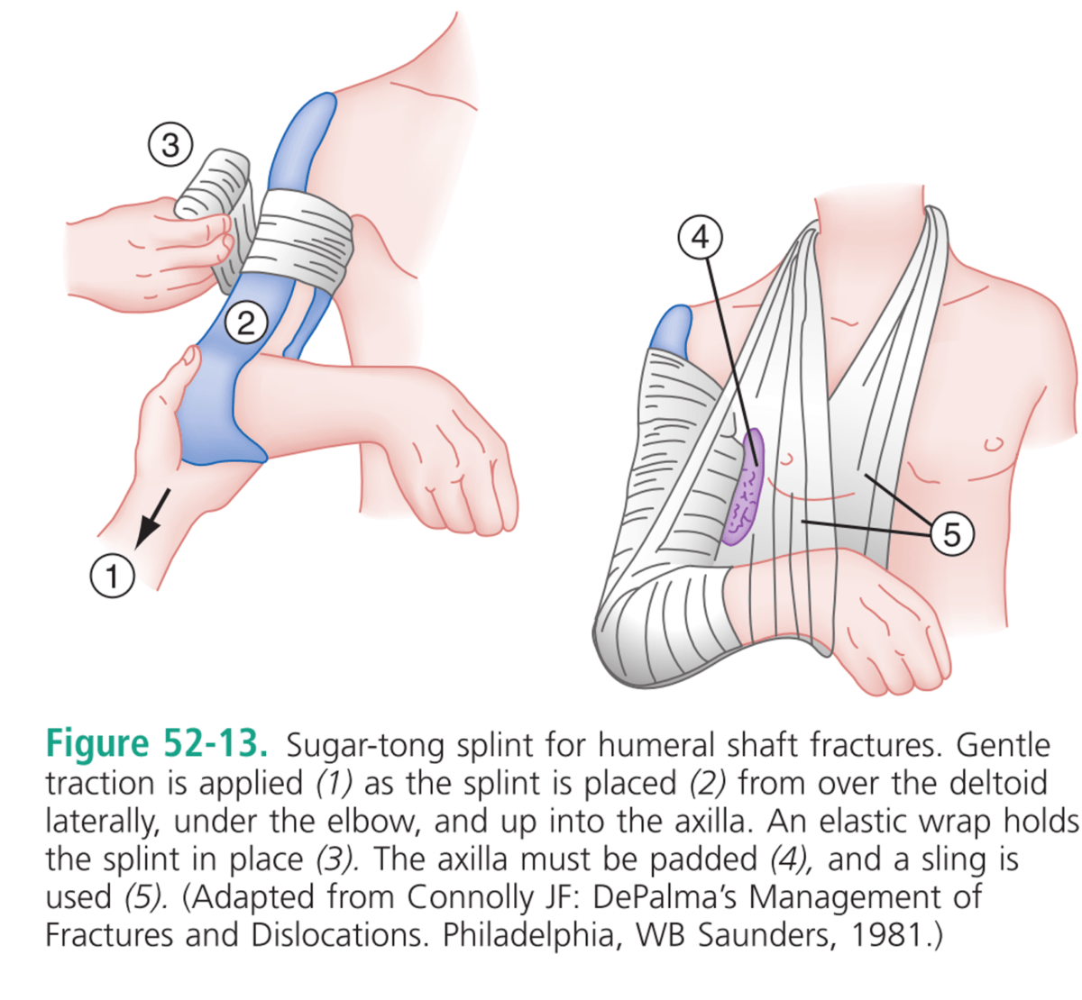 CRACKCast E052 Orthopedics Humerus and Elbow CanadiEM