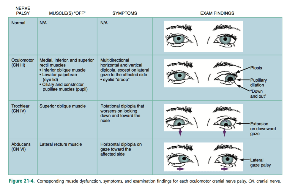 Monocular store binocular diplopia