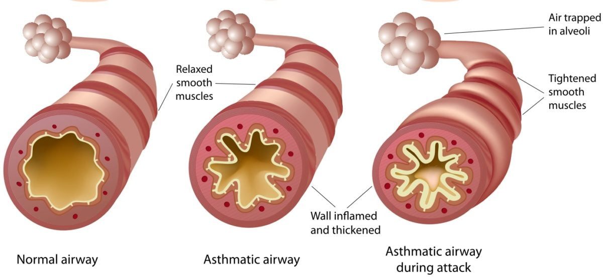 approach-to-asthma-in-the-ed-canadiem