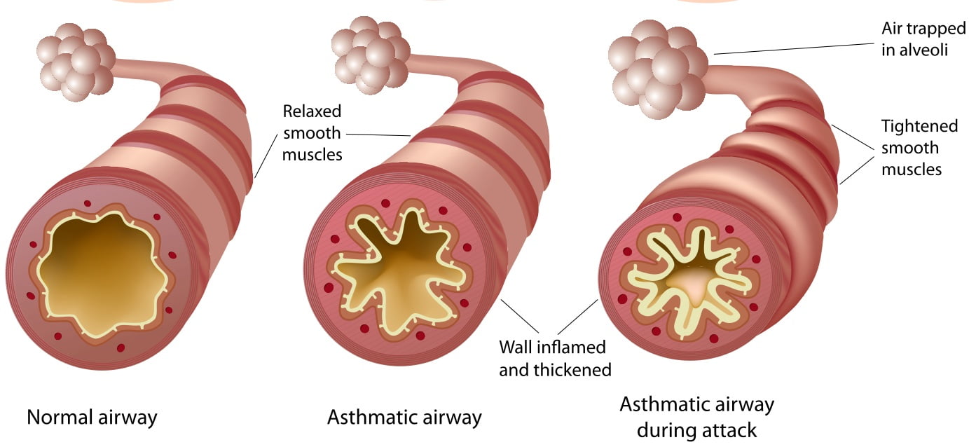 Approach to Asthma in the ED - CanadiEM
