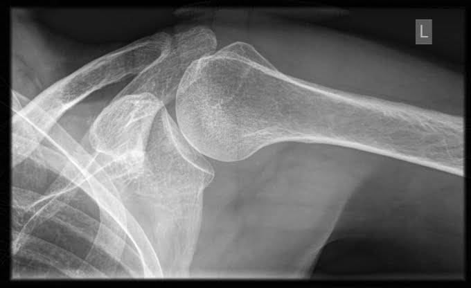 internal rotation shoulder xray