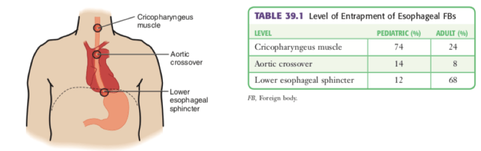 Esophageal foreign bodies