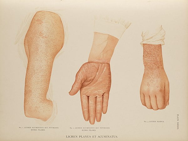 describing-a-rash-canadiem