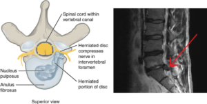 corticosteroids in radicular back pain
