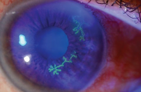 Approach To Corneal Disorders In The Ed Canadiem
