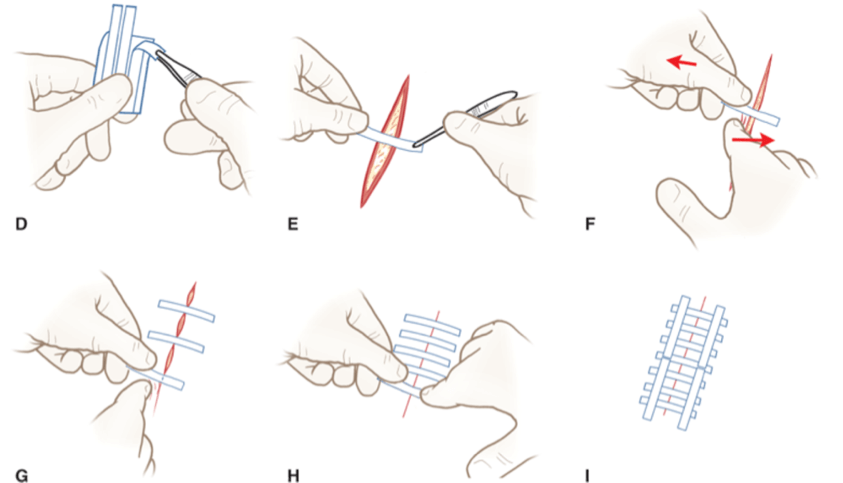 Do I Need Stitches? Here's How To Know