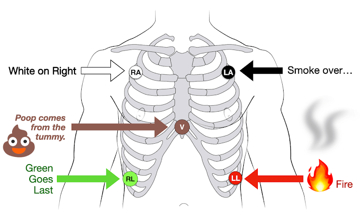 heart monitor lead placement