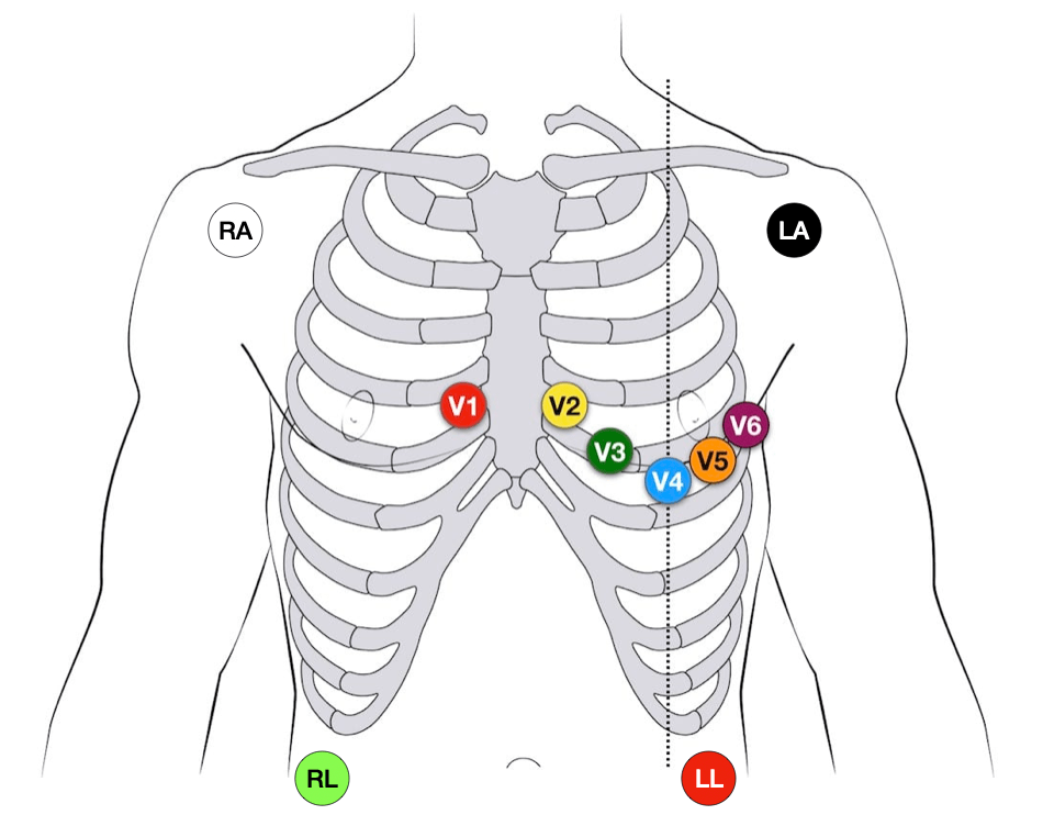 The 10 electrodes for a 12-lead ECG