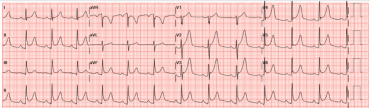 CanadiEM Frontline Primer – ED Skills – ECG Interpretation - CanadiEM